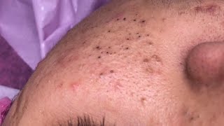 Deep Cleansing [ASMR] Facial Routine for Glowing Skin - Blackhead &amp; Acne Treatment