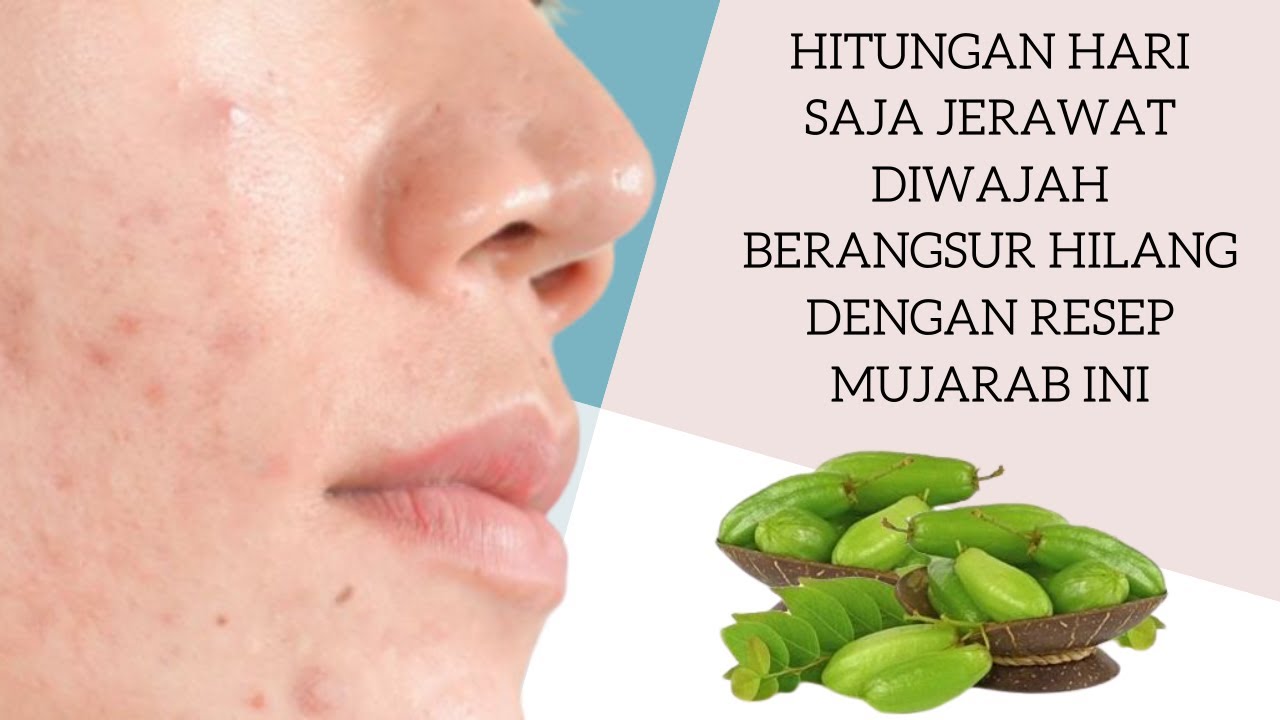 Tips Ampuh Cara Menghilangkan Jerawat Dalam 1 Hari 