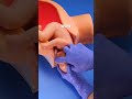 A Complex Delivery Maneuver: Navigating a Nuchal Cord 🩺