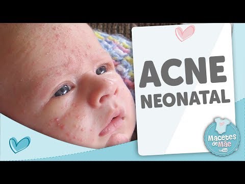 Vídeo: Acne Do Bebê: Causas, Sintomas E Tratamento