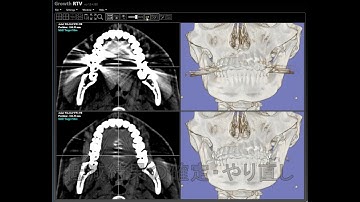 AI based MAR (Metal Artifact Reduction) Demo with "Growth RTV"