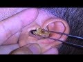 Multiple ear wax fills both men's ears #33