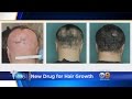 FDA Approves Hair Loss Drug