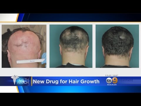 The Laser Comb: FDA Approved Hair Loss Treatment 