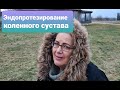 Эндопротезирование коленного сустава, отвечаем на вопросы  в крайнем выпуске по этой теме.