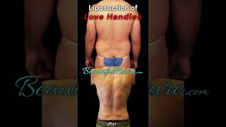 Get rid of Love handles- liposuction in Los Angeles #liposuction #lovehandleworkout #plasticsurgery