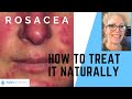 ROSACEA RELIEF: How To Treat Persistent Rosacea & Redness Naturally