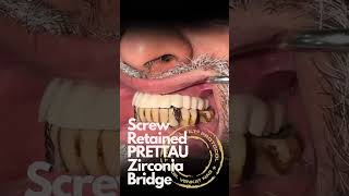 Zirconia Full Arch Bridge | Implant Success in Hyderabad | The Dental Specialists