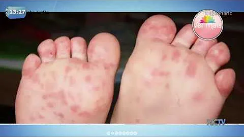 O que é manchas vermelhas na sola do pé?