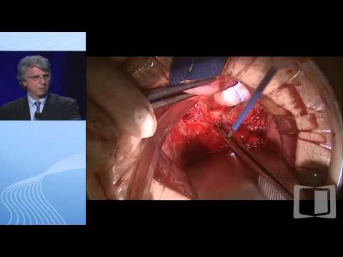 Understanding the techniques of a colectomy with an ostomy, and initial J-pouch surgery