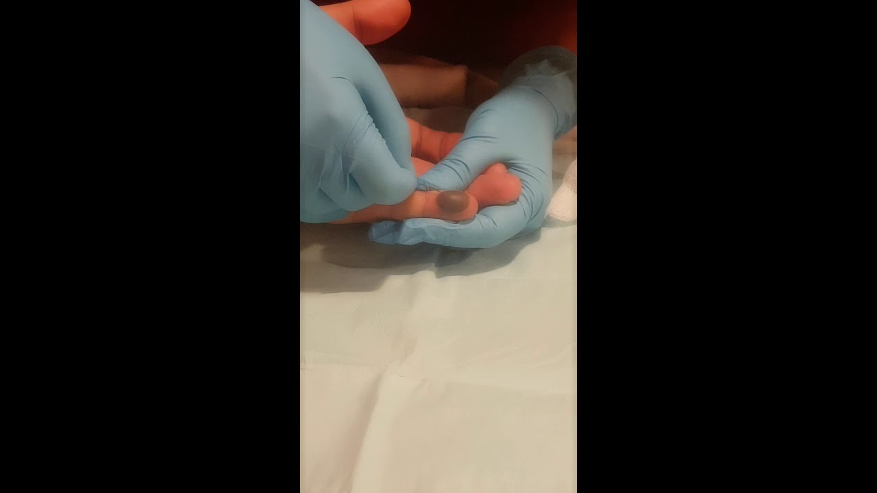 Blood Blister on finger tips!!! YouTube