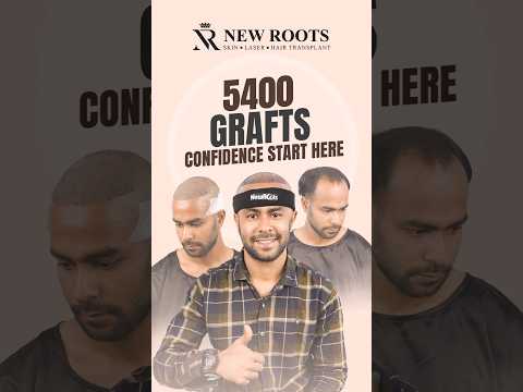 Hair Transplant in Bangladesh - 5400 Grafts | Cost and Procedure #hairtransplant #bangla #shorts