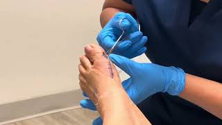 Bunion Surgery/Recovery. Yes it’s wort it. #bunionsurgery #surgeryday #recovery by Veronica Alvarez 389 views 2 weeks ago 6 minutes, 41 seconds