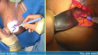 Breast Implant And Capsule Removal - Michael J. Brown, Md Live Stream