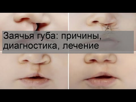 Видео: Почему возникает заячья губа?