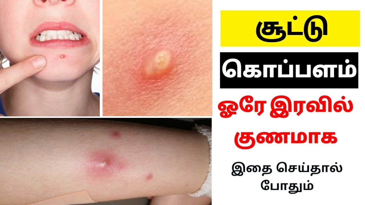 Soodu katti treatment in Tamil YouTube