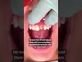 2 front teeth  porcelain crowns  dental crowns before and after  dr yazdan  smile makeover