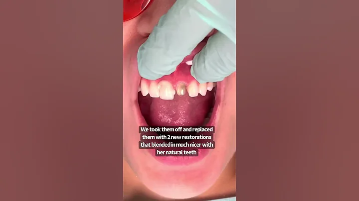 2 front teeth | porcelain crowns | dental crowns before and after | Dr. Yazdan | smile makeover - DayDayNews