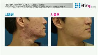 여드름치료 턱여드름 결절성여드름치료 염증성 화농성 여드름치료 | 한의원여드름 턱여드름 성인여드름 볼여드름 | 여드름치료잘하는곳 | 여드름피부한의원