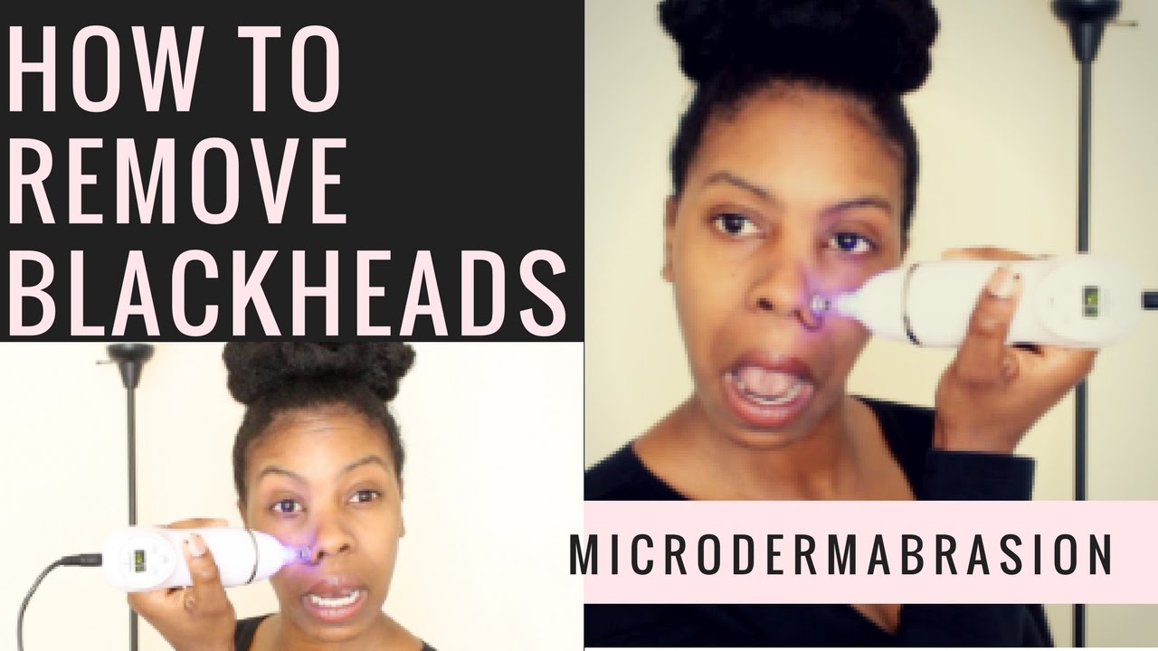 Remove Blackheads with Microdermabrasion [Diamond Peeling] YouTube