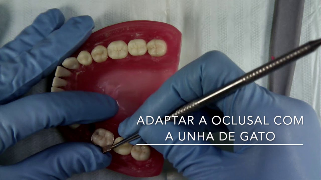 MOLDAGEM DE TRANSFERÊNCIA ORTODONTIA