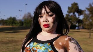 Vitiligo Queen Is Comfortable In Her Own Skin