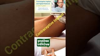 Contraceptive Implant Explained in Hindi #Contraceptive Implant क्या है? #100% Pregnancy Protection!
