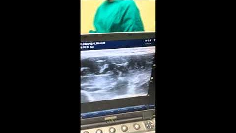Individual nerve blocks upper limb