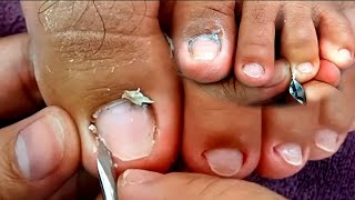 Satisfying Ingrown Toenail Removal | Dry Skin | Pedicure 31