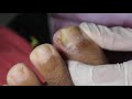 Ep_3045 Toenail removal 👣 อุ้ย..ทำไมออกง่ายจัง 😷 (This clip is from Thailand)