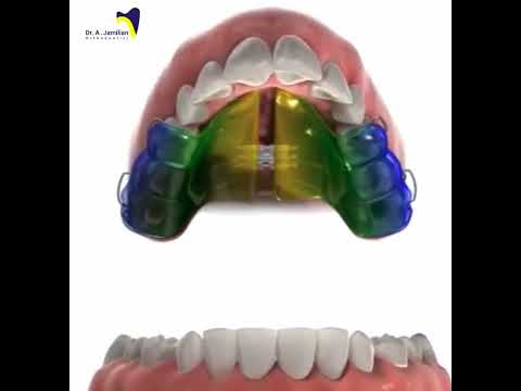 Upper jaw expansion with a removable appliance (3D) – video preview