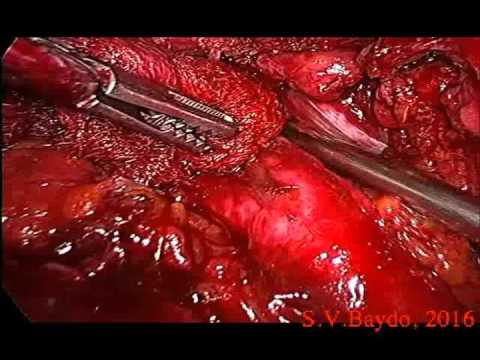 Laparoscopic Management Of Injury Of External Iliac Artery
