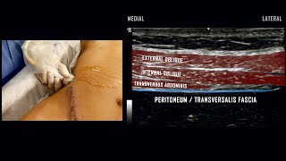 Transversus Abdominis Plane (TAP) Block // Ultrasound-Guided Demonstration