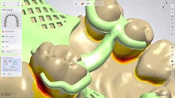 Making of Upper RPD Class II modification 1