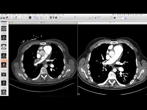 Central Bronchial Carcinoid Tumor