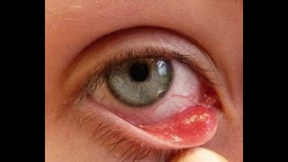 Jęczmień na oku: przyczyny, objawy i leczenie