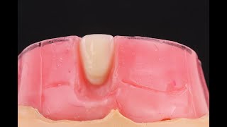 1er Enfilado 11 y 21. Parte 1