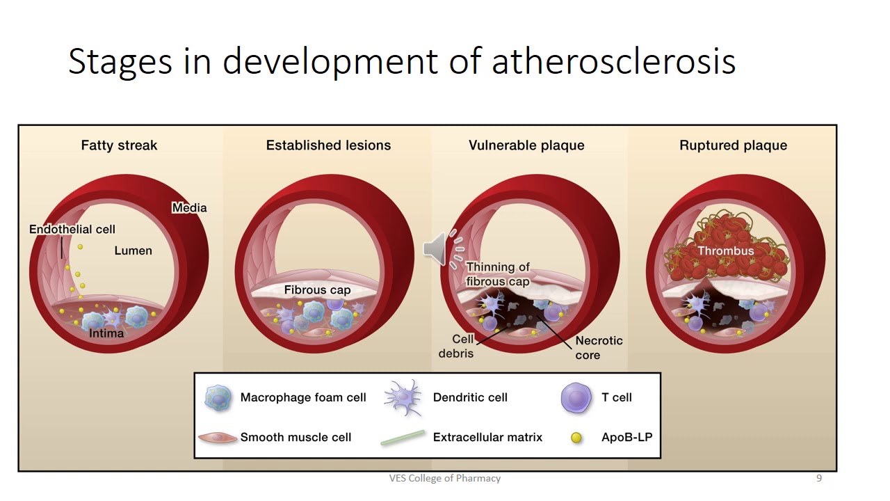 Pathophysiology and inflammation in atherosclerosis (Pathophysiology ...