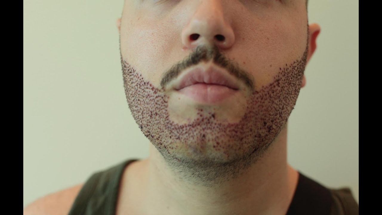 First wash postop Beard Transplant Dr Arslan Musbeh YouTube