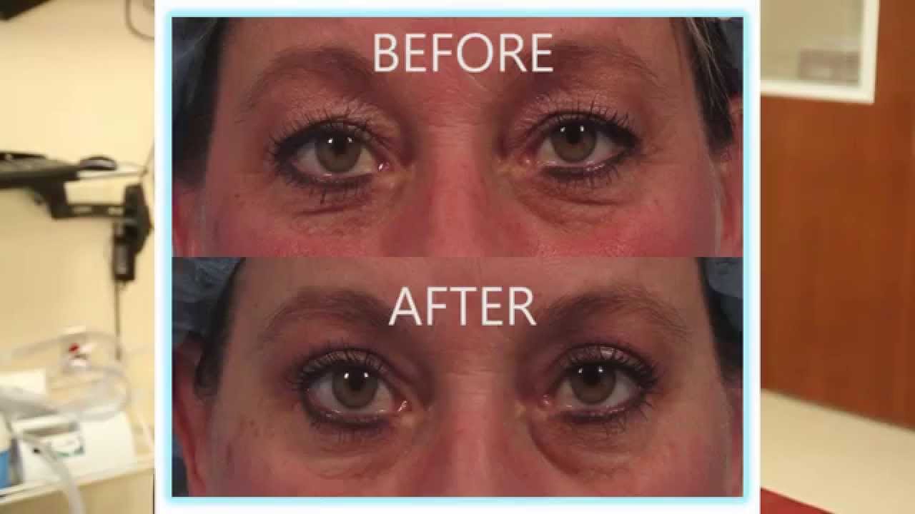 What is laser eyelid lift Dr. Kotlus YouTube
