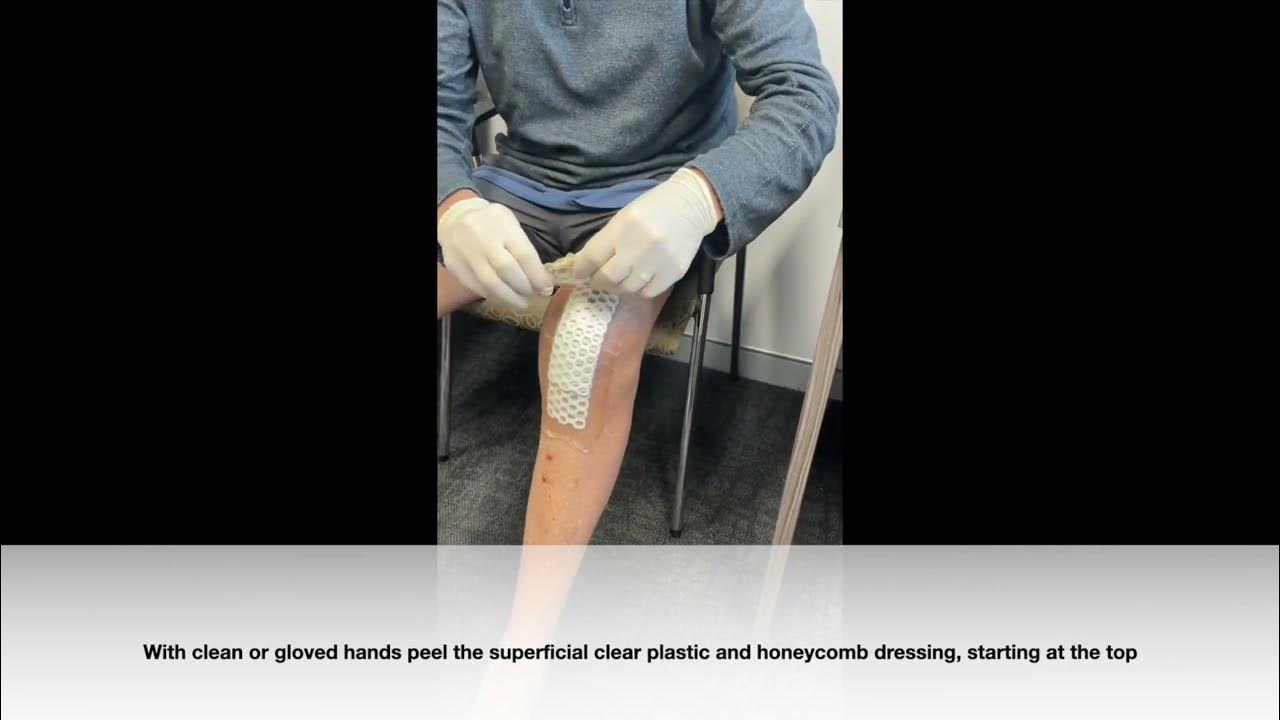 removal-of-dressing-after-knee-replacement-surgery-youtube