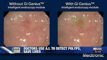 Medical Moment: Using AI to remove cancerous colon polyps