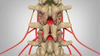 Laminectomy - Patient Education