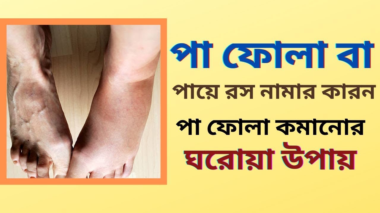 পা ফোলা বা পায়ে রস নামার কারন/ পা ফোলা কমানোর ঘরোয়া উপায়/ Home remedy for legs Edema YouTube