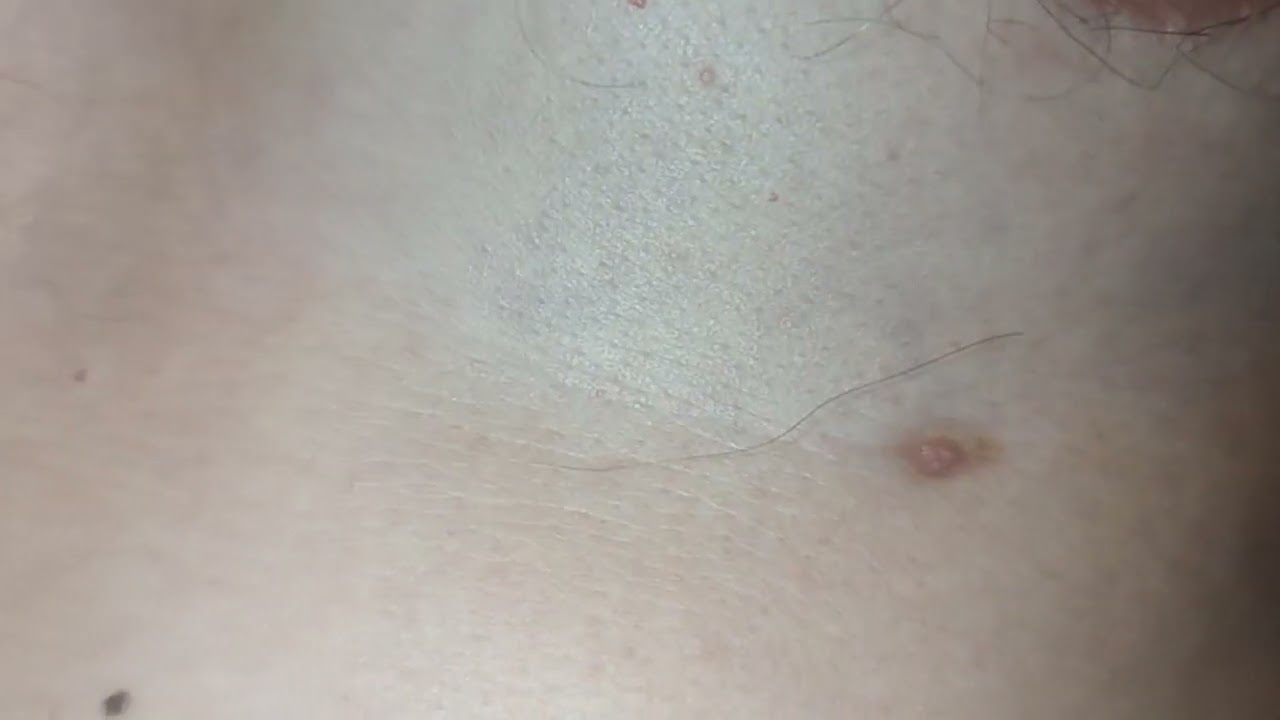 Third Nipple On Male YouTube Third Nipple On Male YouTube