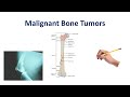 Malignant Bone Tumors | USMLE COMLEX NCLEX