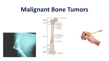 Malignant Bone Tumors | USMLE COMLEX NCLEX