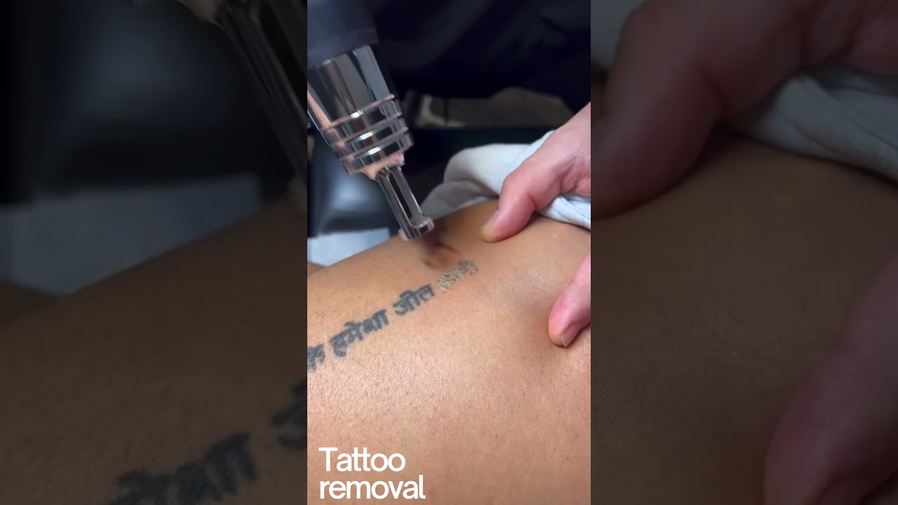 Tattoo Removal Session at Alternative Laser Health | Effective Laser Treatment