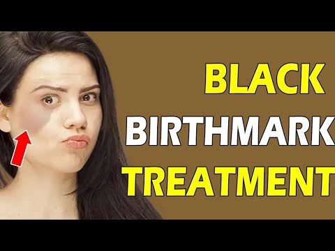 How to Remove Your Birthmarks? by Dr. Swapna Priya | COSMOSURE Clinic, HITEC City