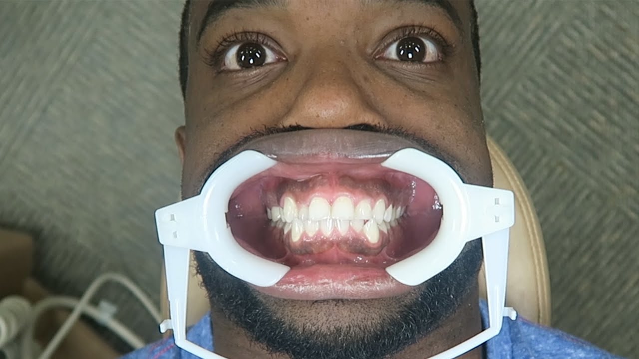 Please Don't Roast Me! I Finally Got Braces!! YouTube